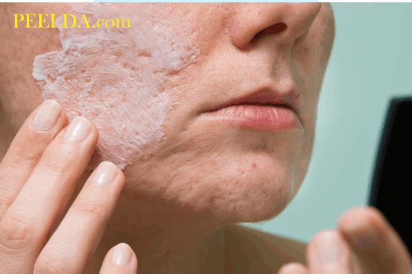 Tại sao nên sử dụng Benzoyl Peroxide trị mụn dưới da