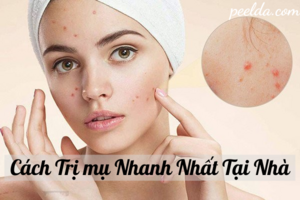 9 Cách Trị Mụn Nhanh Nhất Trong 1 Ngày Tại Nhà Tốt Nhất