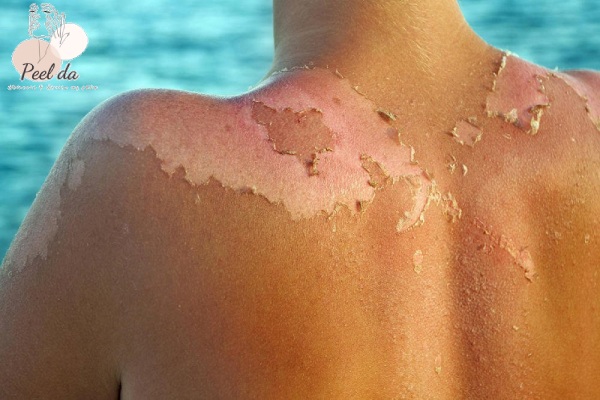 Khô da là tác hại của việc không sử dụng kem chống nắng